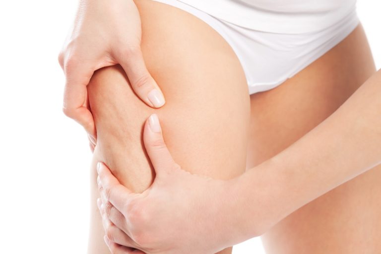 Pierna con celulitis, Curso Reductor y Anticelulitico de García y Lledó, Alicante.